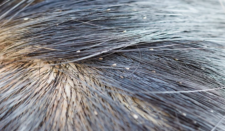 Peut-on savoir si on a des poux sans peigne fin ?  Peut-on savoir si on a des poux sans peigne fin ?