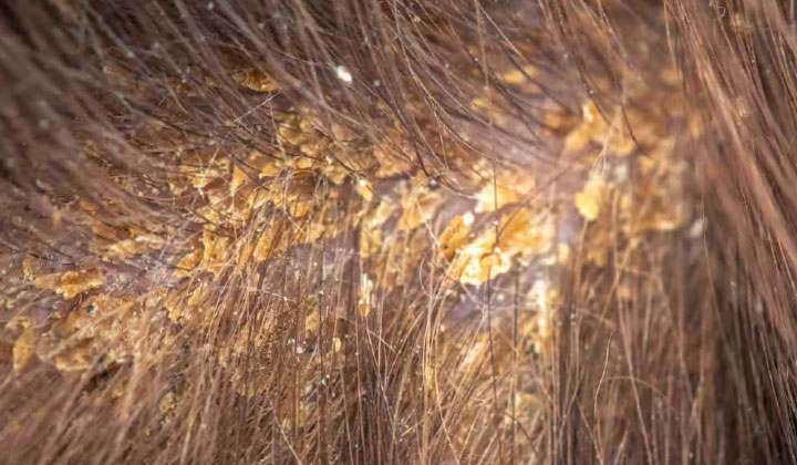 Er is sprake van seborroïsch eczeem wanneer de Malasseziacellen voor 83% aanwezig zijn. 
