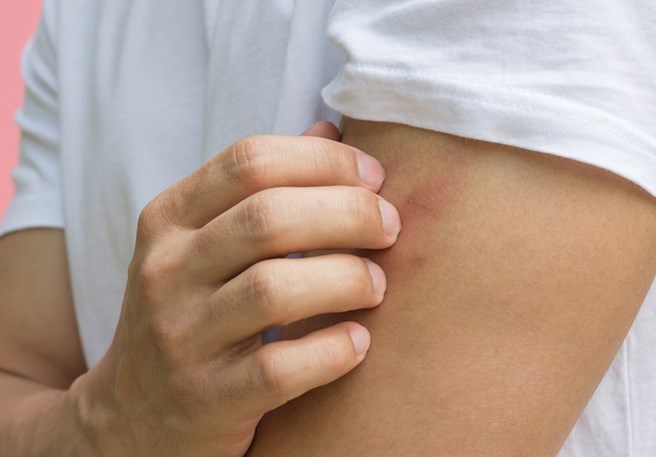 Kom erachter wat de symptomen van eczeem zijn.