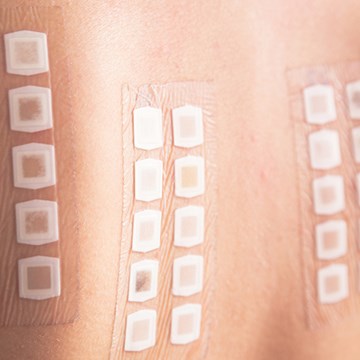 Via plakproeven op de huid kan een arts achterhalen voor welke stof je allergisch bent.