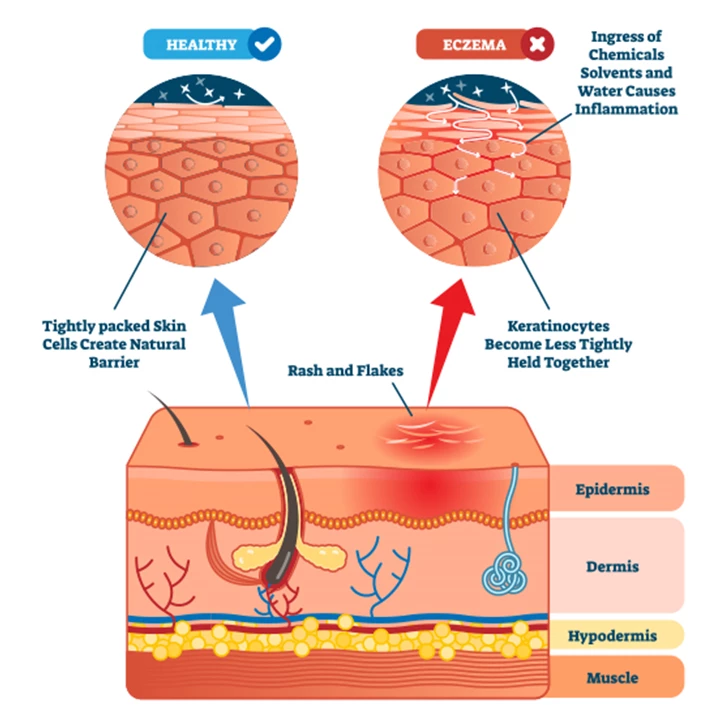 Eczeem is een chronische huidaandoening die uiteenlopende oorzaken kan hebben.