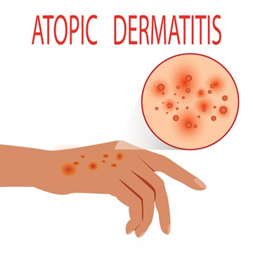 Atopische dermatitis is de meest voorkomende van eczeem en heeft vaak een genetische oorzaak.