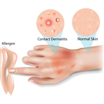 Contactallergie ontstaat na huidcontact met een bepaald allergeen.