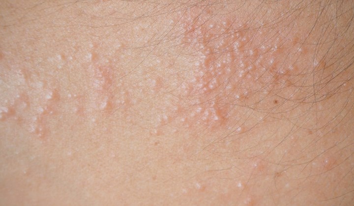 Sommige vormen van eczeem hebben als symptoom jeukende vochtblaasjes die kunnen opdrogen tot korstjes.