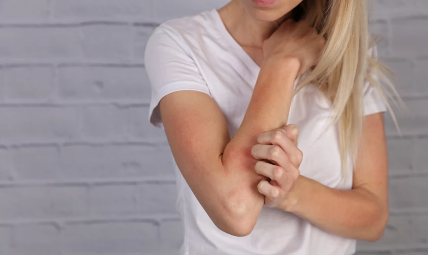 L'eczéma peut-il être contagieux? L'eczéma peut-il être contagieux?