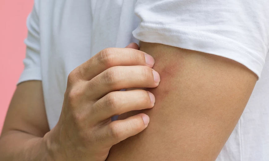 La peau peut réagir de différentes façons aux allergies.