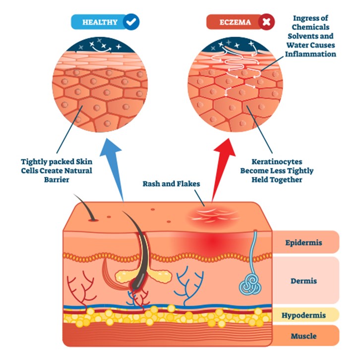 L'eczéma est une affection cutanée chronique qui peut avoir des causes diverses.