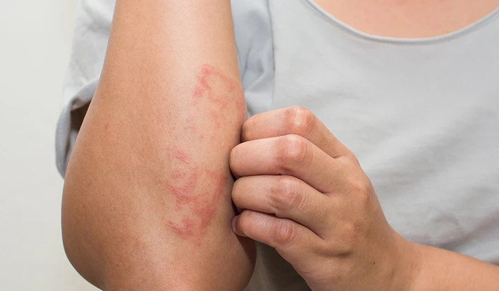 L'eczéma présente différents symptômes tels que des démangeaisons, des rougeurs, des bosses et des squames.