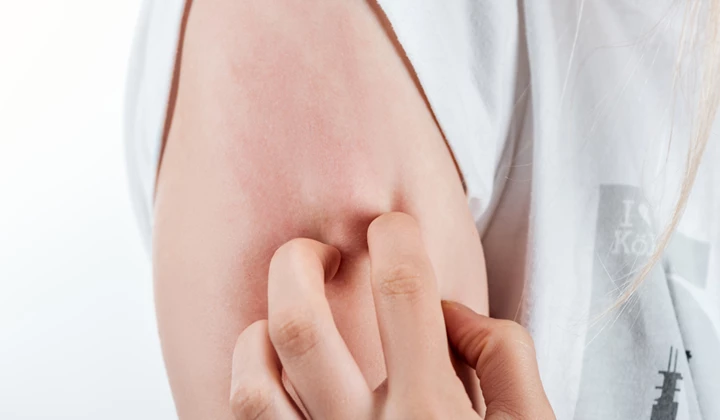 Les démangeaisons et l’eczéma vont de pair. Les personnes qui souffrent d'eczéma ressentent aussi souvent le besoin de se gratter.