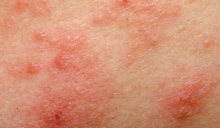 Des cloques rouges qui démangent sont également un symptôme typique de l'eczéma.
