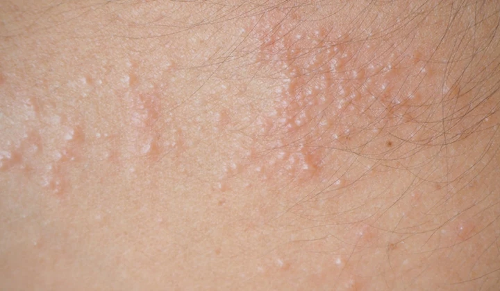 Certaines formes d'eczéma ont pour symptôme des vésicules qui démangent et qui peuvent se sécher en croûtes.