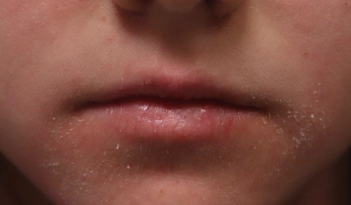 Des pellicules en grande quantité peuvent indiquer la présence de séborrhée ou d'eczéma séborrhéique.