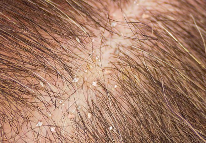 Il y a aussi des pellicules sur un cuir chevelu normal.