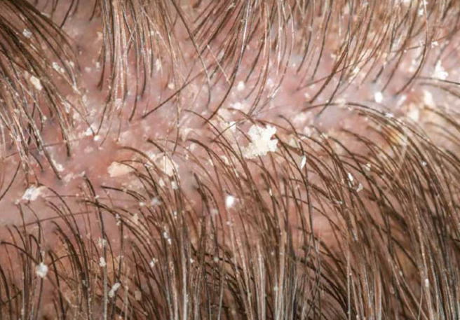 Lorsqu’ il y a environ 74% de cellules malassezia sur le cuir chevelu, on parle de pellicules.