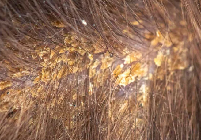 On parle d'eczéma séborrhéique lorsque les cellules Malassezia sont présentes à 83 %.