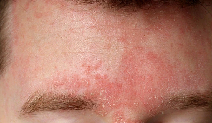 Lorsque le champignon Malassezia furfur commence à proliférer, le patient peut développer un eczéma séborrhéique.