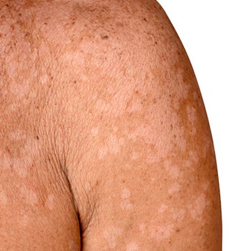 La maladie de peau pytiriasis versicolor est causée par le Malassezia furfur et peut donc également être traitée avec du kétoconazole.
