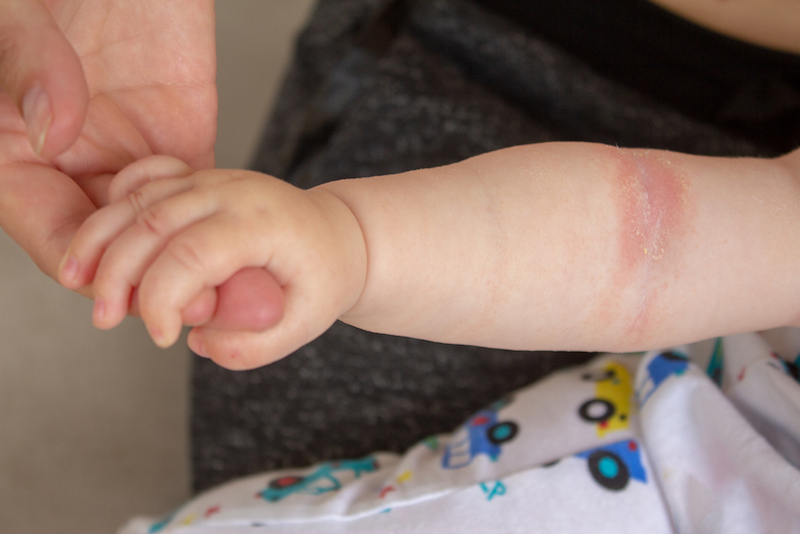 Eczema Chez Mon Bebe Que Dois Je Faire Eg