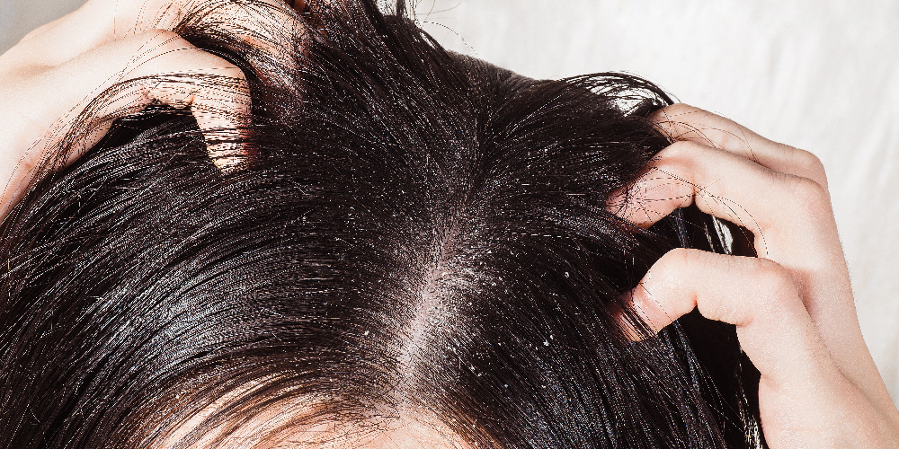 ziekenhuis Arab kapperszaak Wat kan je doen tegen een vettige hoofdhuid? | EG