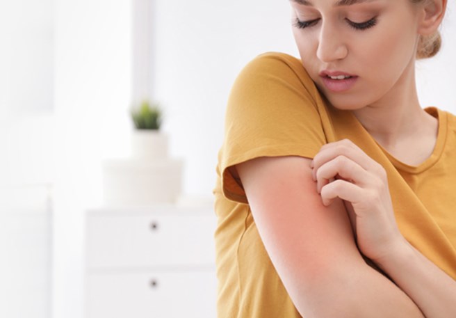 Des problèmes d'urticaire ? Voici les meilleurs traitements pour soulager vos symptômes