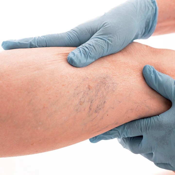 mode de vie sain Un mode de vie sain, une compression médicale avec des bas de soutien et des médicaments aident à traiter les plaintes d'insuffisance veineuse chronique